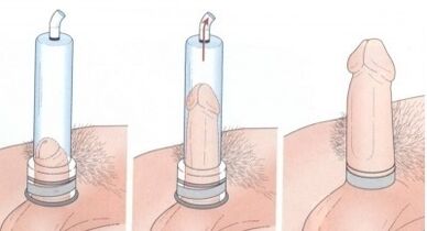 Use a pump to enlarge your penis